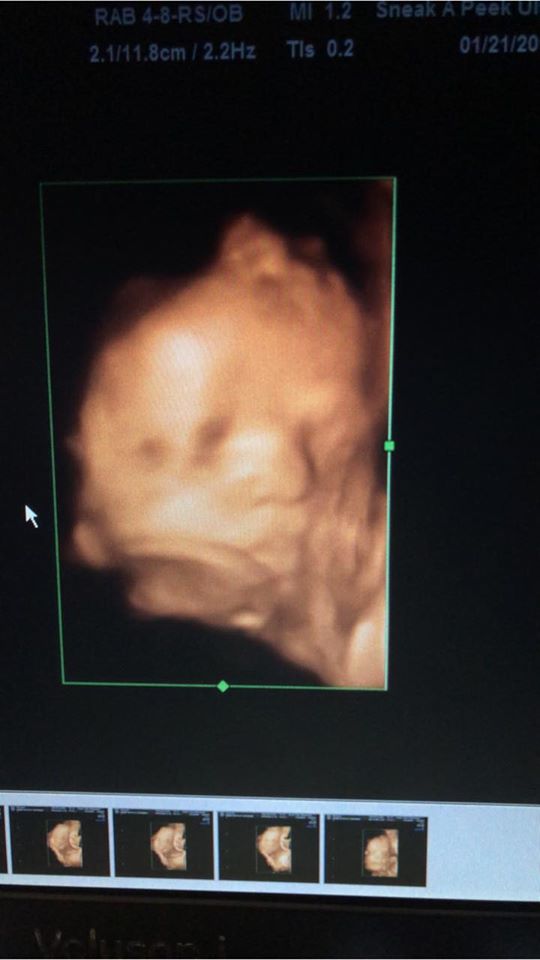 ultrasound Beaumont, new moms SETX, ultrasound Southeast Texas, Golden Triangle Ultrasounds