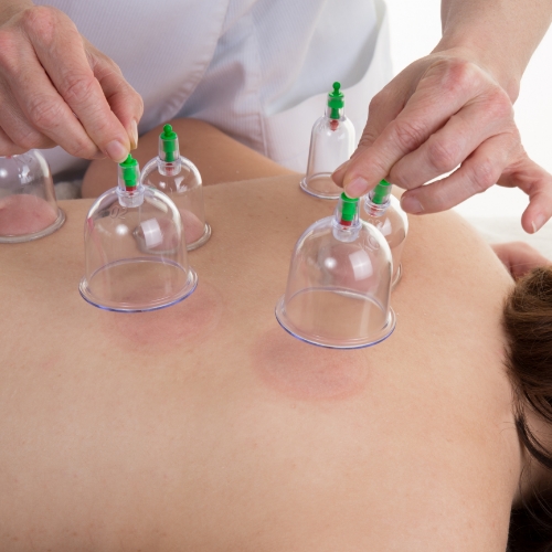 cupping in Southeast Texas, who offers cupping Beaumont TX, cupping therapy Golden Triangle, is cupping available in Lumberton TX?
